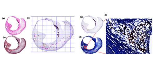 Characterization of the Atherosclerotic Plaque Tissue