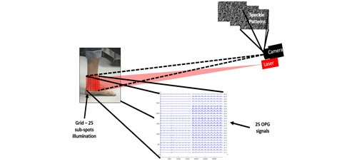 Remote photonic sensing of glucose concentration via analysis of time varied speckle patterns